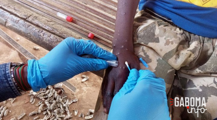 Mpox en Afrique : les enfants particulièrement menacés par la nouvelle variante