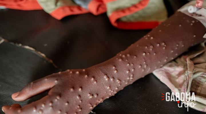 Mpox : l’OMS donne son feu vert au vaccin de Bavarian Nordic pour les adolescents