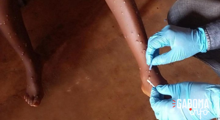 Mpox : l’OMS approuve le premier test de diagnostic pour une utilisation en situation d’urgence